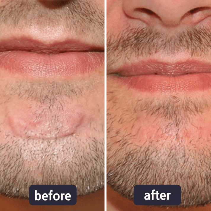 Professional Wart & Scar Removal Cream – Safe, Gentle & Effective Skin Care