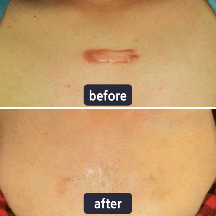 Professional Wart & Scar Removal Cream – Safe, Gentle & Effective Skin Care