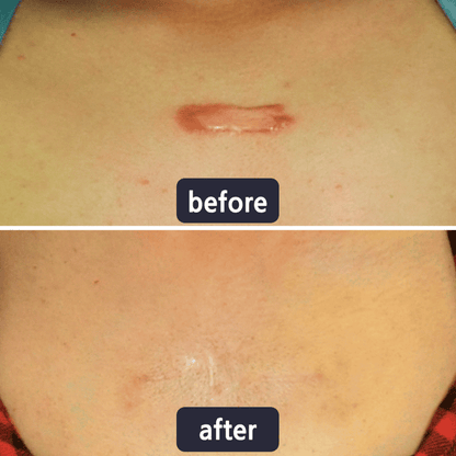 Professional Wart & Scar Removal Cream – Safe, Gentle & Effective Skin Care