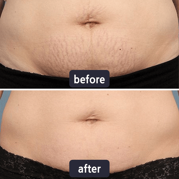 Professional Wart & Scar Removal Cream – Safe, Gentle & Effective Skin Care