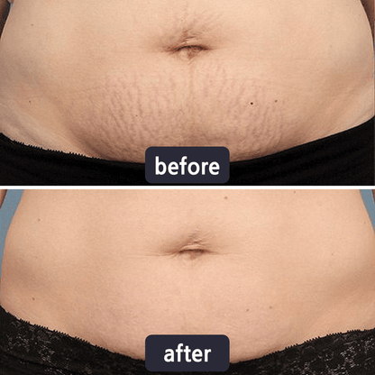 Professional Wart & Scar Removal Cream – Safe, Gentle & Effective Skin Care